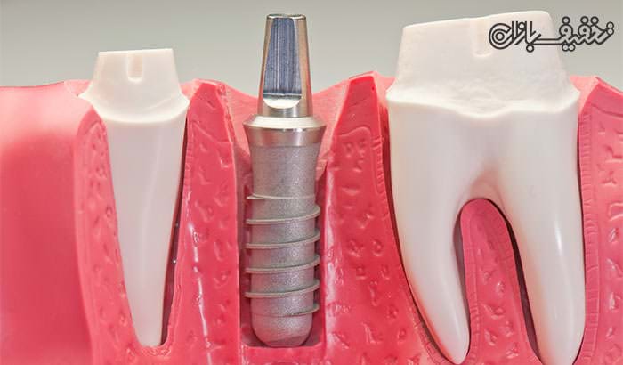 ایمپلنت دندان توسط متخصص در مطب دندانپزشکی مهتاب