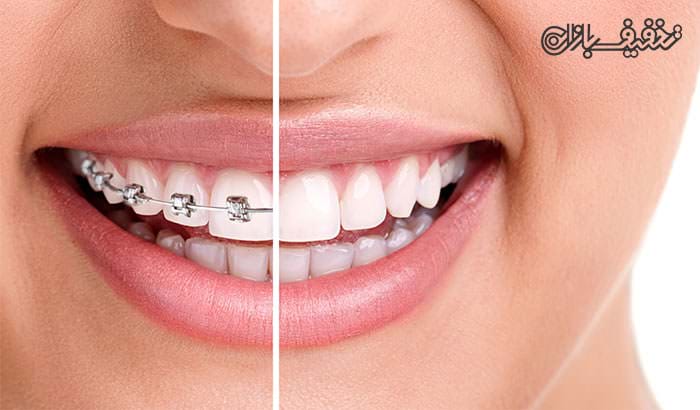 ارتودنسی دندان توسط متخصص در مطب دندانپزشکی مهتاب