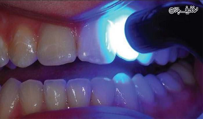 ترمیم دندان ها با ۵۰ درصد تخفیف