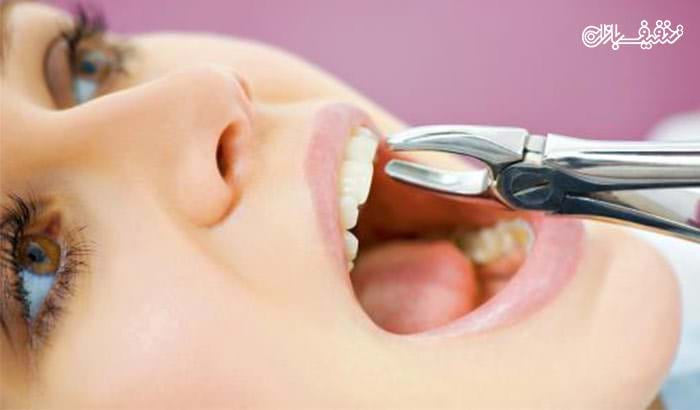 کشیدن دندان با ۵۰ درصد تخفیف
