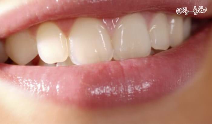 کوپن تخفیف ۵۰ درصدی ترمیم دندان