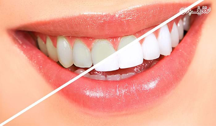 بلیچینگ (سفید کردن دندان) در مطب دندانپزشکی دکتر حق دوست