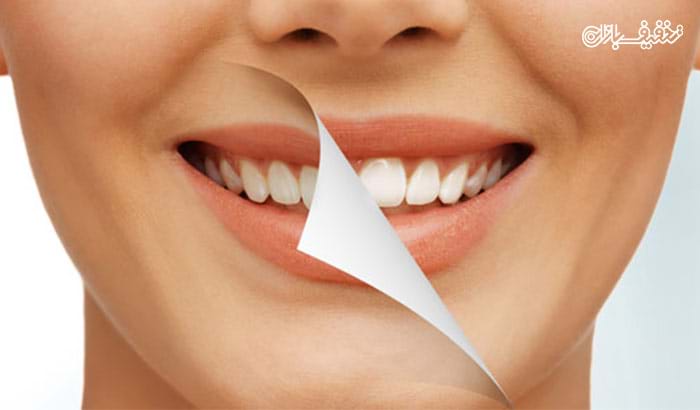 بلیچینگ (سفید کردن دندان) در مطب دندانپزشکی دکتر حق دوست