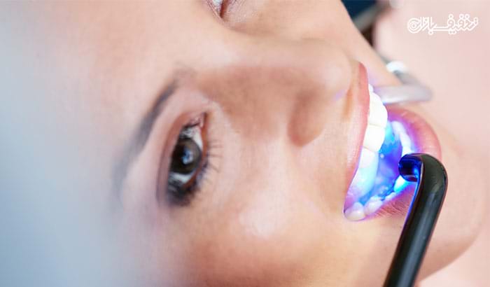 تخفیف ترمیم و پرکردن دندان در مطب دندانپزشکی دکتر کامران افشین