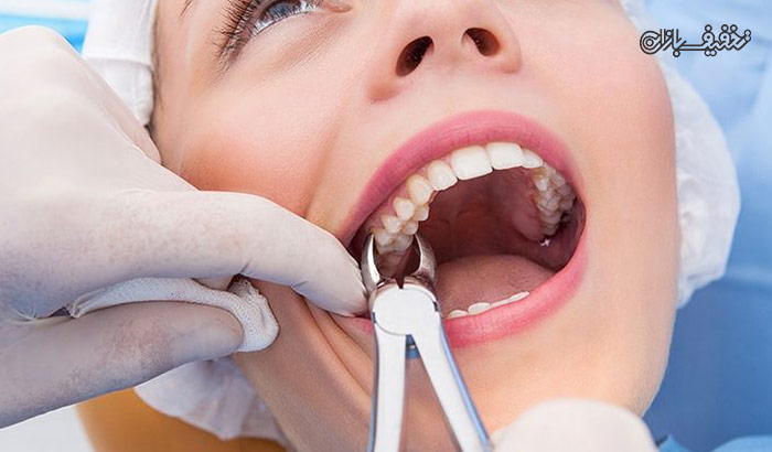 کشیدن ریشه دندان در مطب دندانپزشکی دکتر اکبری