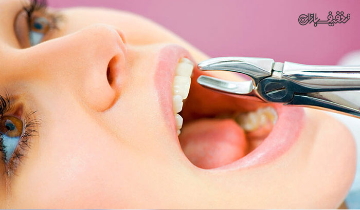 کشیدن ریشه دندان در مطب دندانپزشکی دکتر اکبری