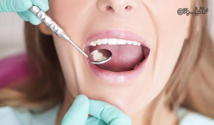 پر کردن دندان با استفاده از مواد کامپوزیت ویژه و معمولی در مطب دندانپزشکی دکتر اکبری 