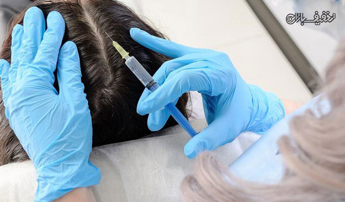 مزوتراپی جهت کنترل و درمان ریزش مو در مرکز زیبایی مارینا