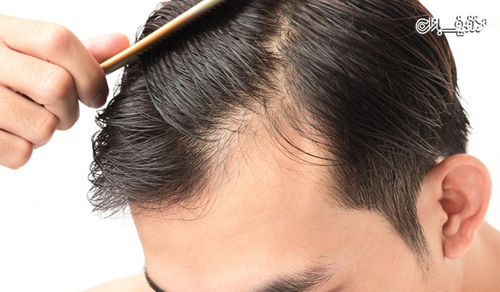 جلوگیری از ریزش و رشد مجدد مو با PRP در مرکز زیبائی رویا