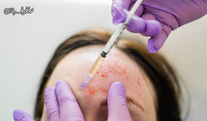 جوانسازی صورت و درمان ریزش مو با پی آر پی (PRP) در مطب دکتر فرهام دهقان شاه سلطنه