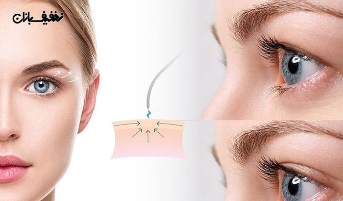 درمان افتادگی پلک و کوچک کردن بینی با پلاسماجت در مجتمع پزشکی گلستان