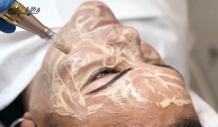 روشن سازی ثابت پوست با مزو وایت در مجتمع پزشکی گلستان
