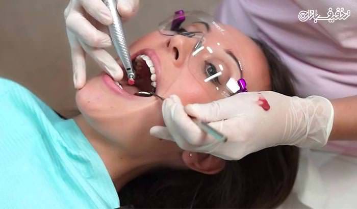 کوپن تخفیف ۶۲ درصدی جرمگیری دندان همراه با بروساژ