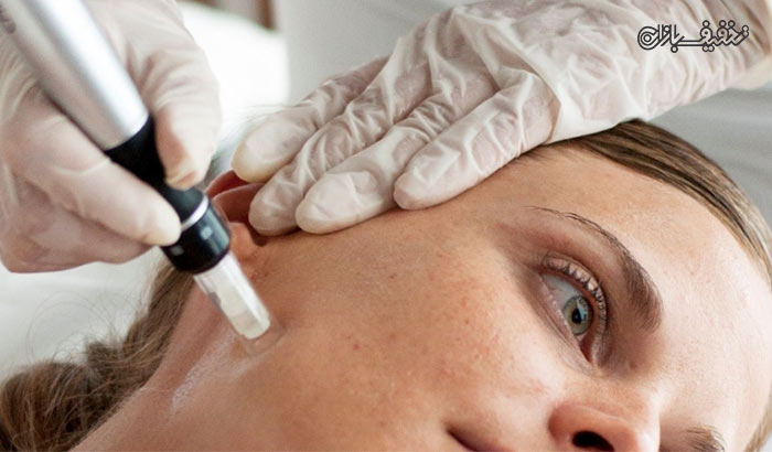 روش نوین درمان چروک، جای جوش و لک صورت با درماپن نیدلینیگ و مزوتراپی در درمانگاه سینوهه