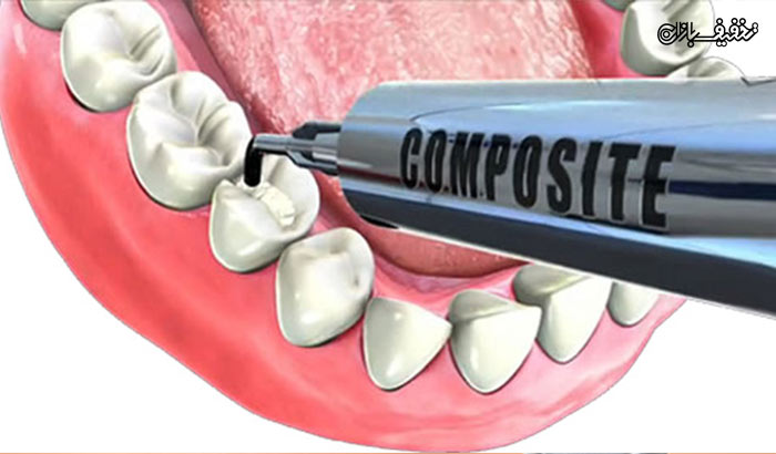 دندان های سفید و سالم با ترمیم کامپوزیت در مطب دکتر بهاره مظهری