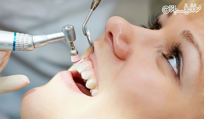 جرمگیری دندان همراه با بروساژ در مطب دندانپزشکی مهتاب