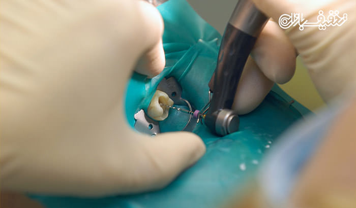 عصب کشی دندان توسط متخصص در مطب دندانپزشکی مهتاب
